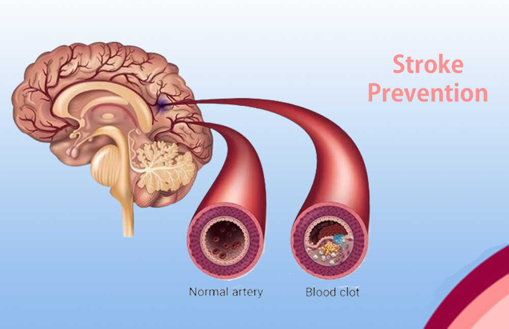 Prevention How to Prevent Brain Stroke